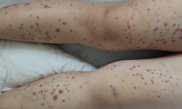 中医调养小儿过敏性紫癜