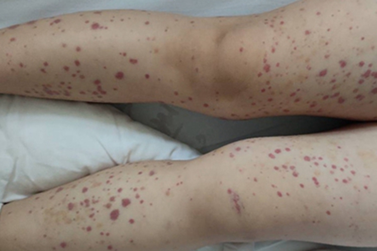 中医调养小儿过敏性紫癜