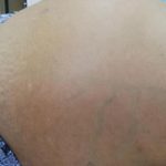 肝硬化八大并发症