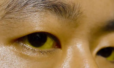 胰腺癌为什么难以发现？