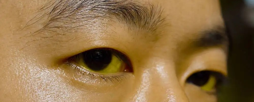 胰腺癌为什么难以发现？